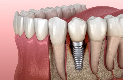 a 3D illustration of dental implants