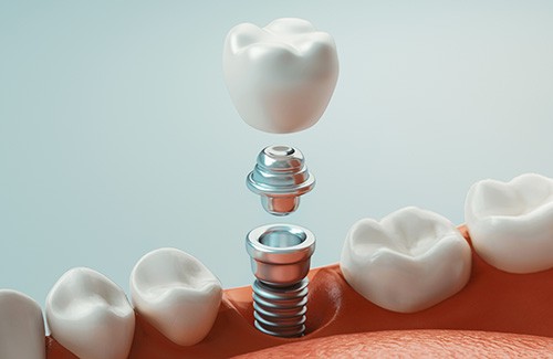 a 3D illustration of a dental implant restoration 