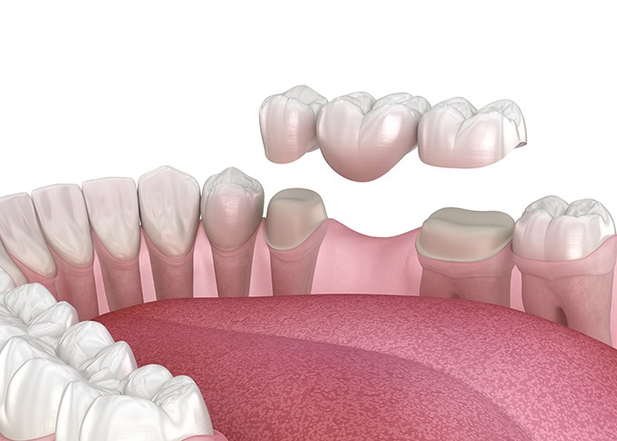 A dental bridge can replace multiple lost teeth in one treatment