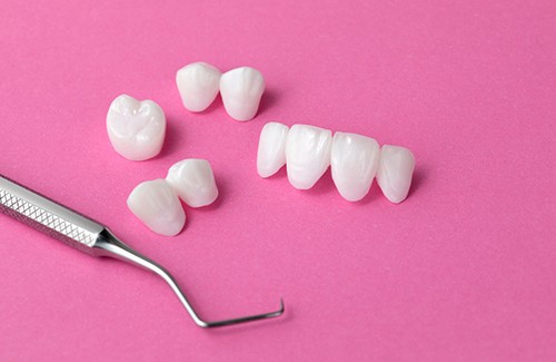 A dental bridge is a prosthetic used to replace missing teeth