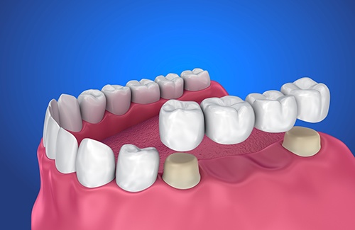 There are several different types of dental bridges