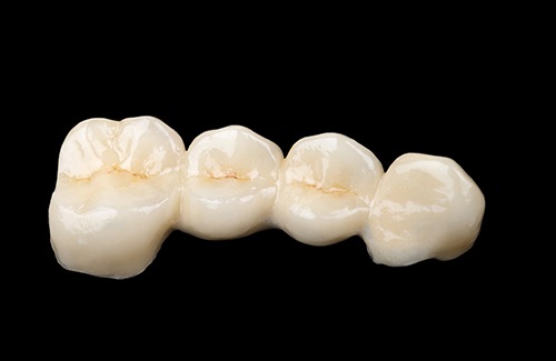 Traditional dental bridges can last a decade or longer