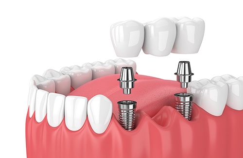 A dental implant bridge attaches permanently via dental implants