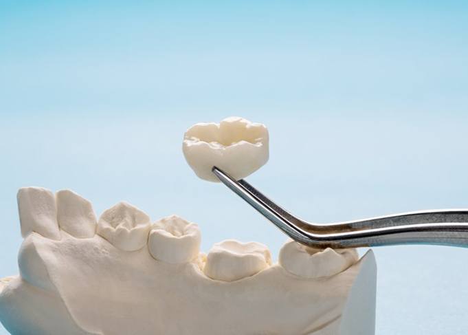 Close up of tweezers carefully lifting a dental crown from wax model