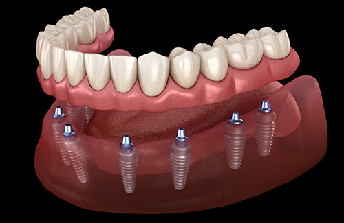 Illustration of a lower arch of implant dentures with black background