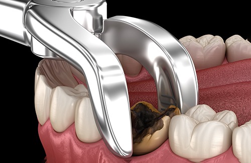 Illustration of forceps grasping a severely decayed tooth